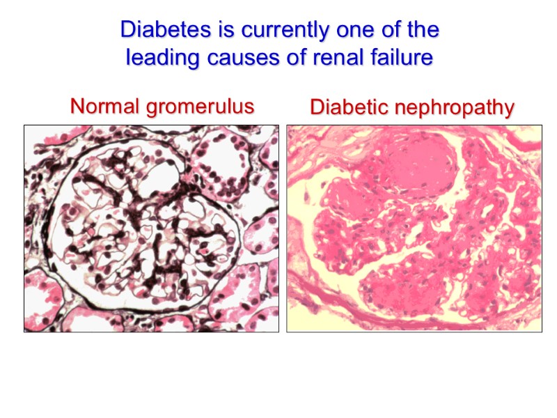 Diabetes is currently one of the leading causes of renal failure Normal gromerulus Diabetic
